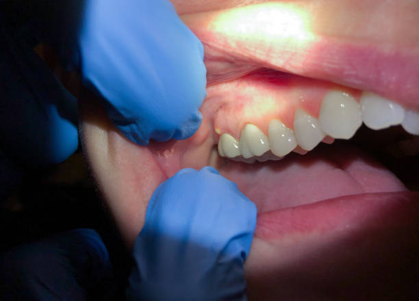 Best Knocked-Out Tooth (Avulsed Tooth) Treatment in Riverbank, CA