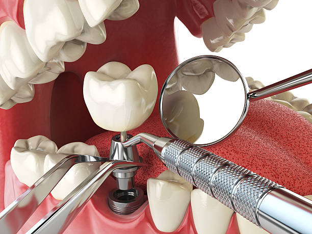 Best Broken or Chipped Tooth Repair in Riverbank, CA